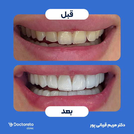 ترمیم کامپوزیت