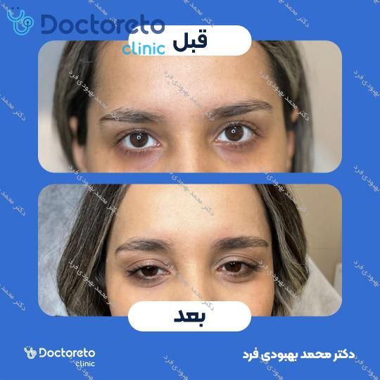 تزریق بوتاکس صورت 💉