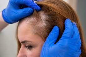 آزمایش ریزش مو در زنان