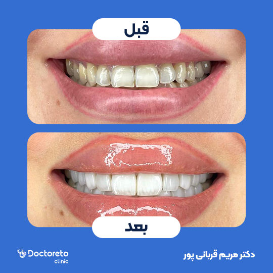 روکش دندان زیرکونیا و PSM (هرواحد)