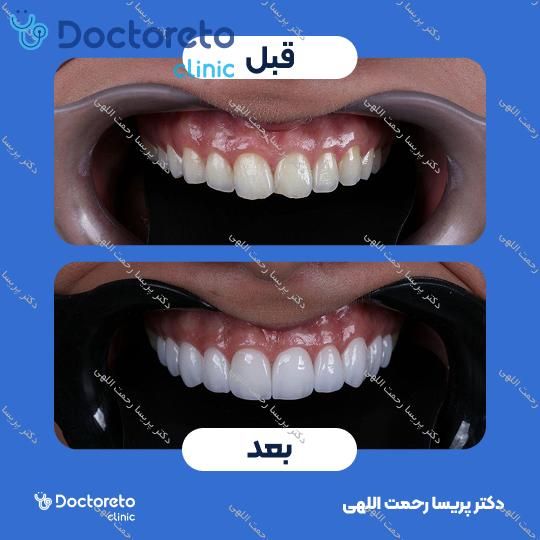 ونیر کامپوزیت الترادنت آمریکایی (هر واحد)
