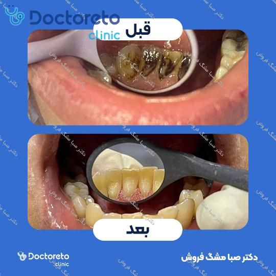 جرم گیری دندان با بروساژ 🦷