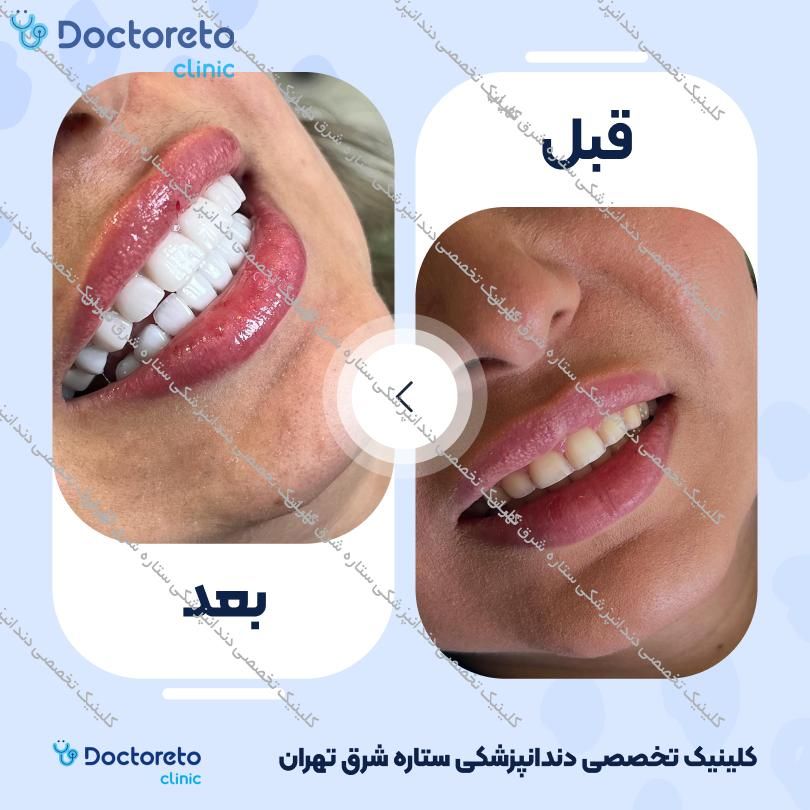 روکش دندان (هر واحد)