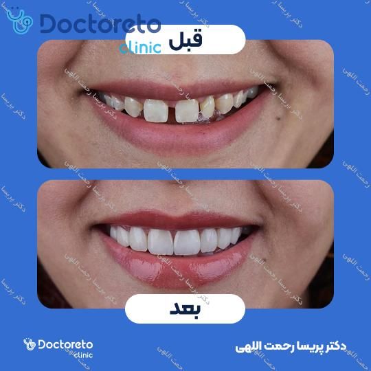 ونیر کامپوزیت توکویاما ژاپنی (هر واحد)