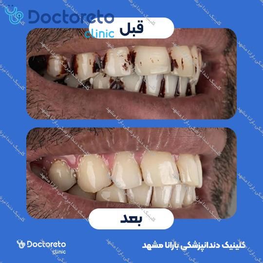 جرم گیری دندان با بروساژ🦷