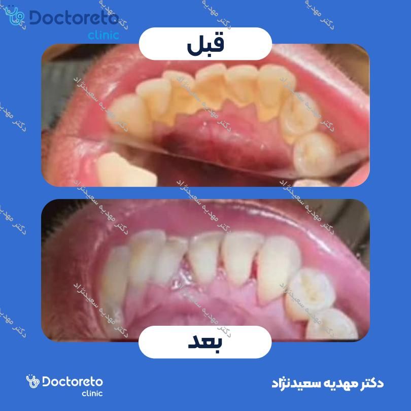 جرم گیری دندان با بروساژ🦷