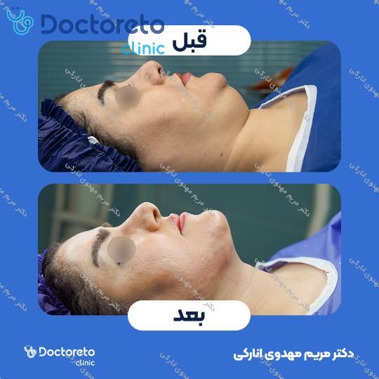 رفع غبغب به روش ساکشن