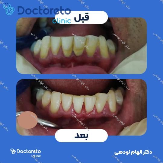 جرم گیری دندان با بروساژ🦷