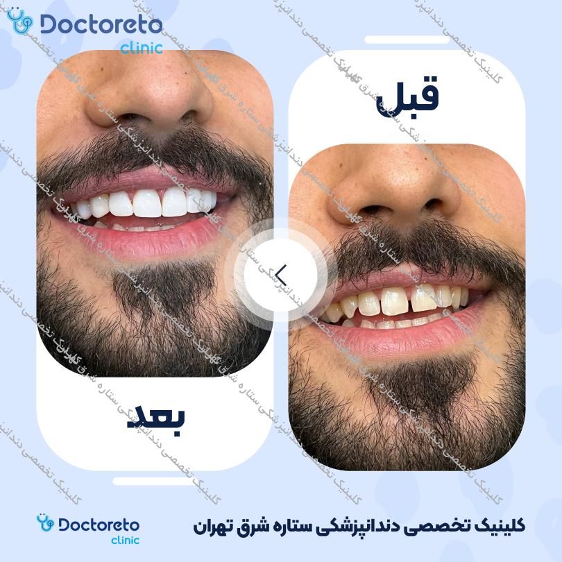 روکش دندان (هر واحد)
