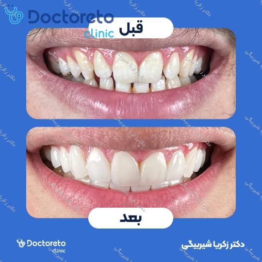 ونیر کامپوزیت (هر واحد)