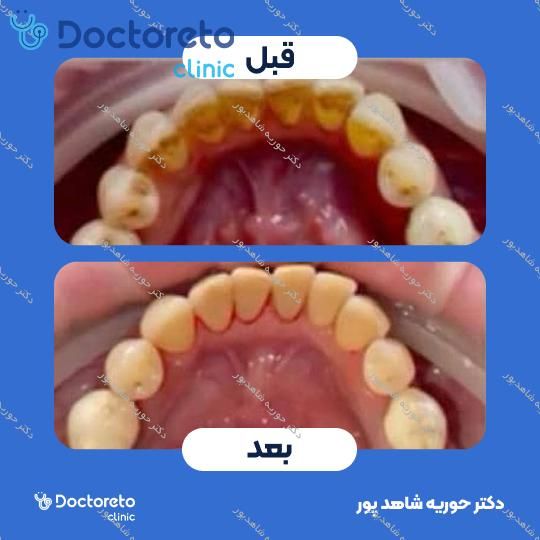 جرم گیری دندان با بروساژ🦷