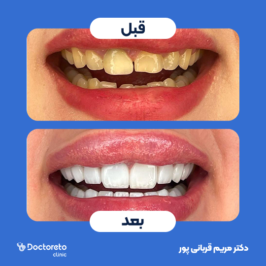 لمینت دندان (هرواحد)
