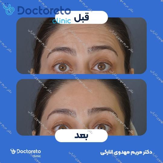 تزریق بوتاکس صورت
