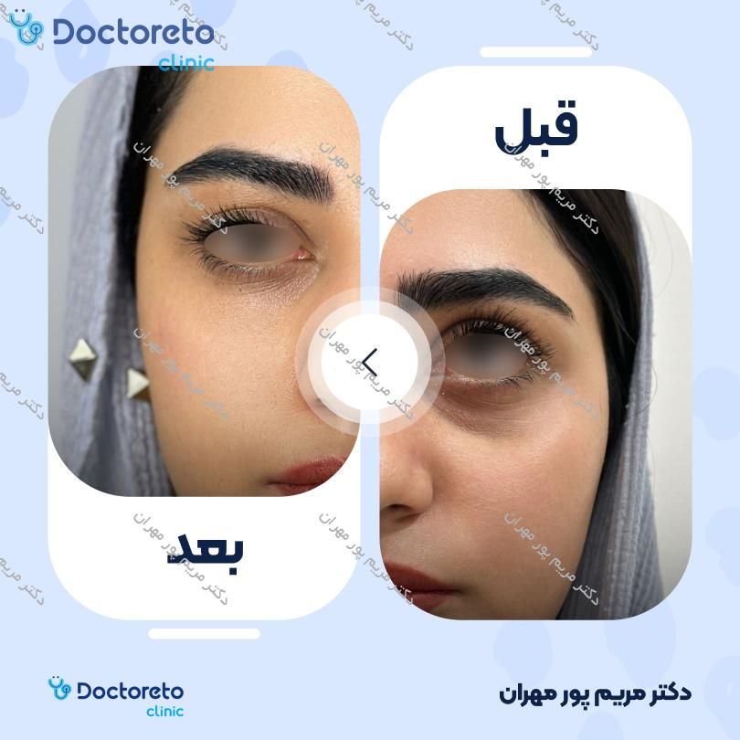 تزریق بوتاکس صورت 💉