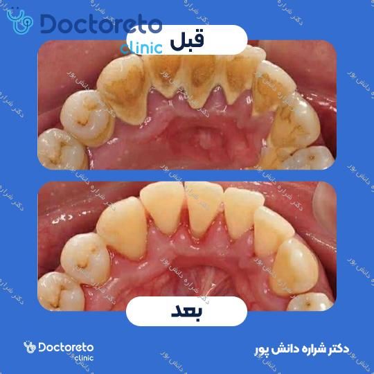 جرم گیری دندان با بروساژ 🦷