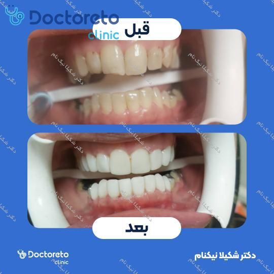 جرم گیری دندان با بروساژ 🦷