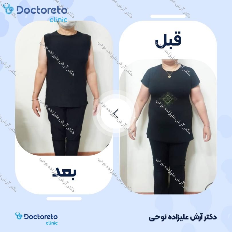 لاغری موضعی با دستگاه کویتیشن، به همراه و رژیم لاغری