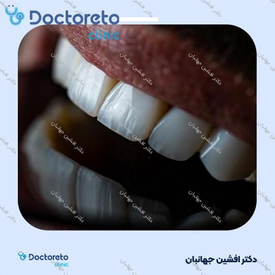 روکش دندان (هر واحد)