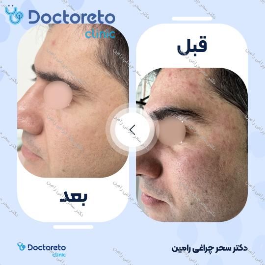 درمان جای جوش و منافذ باز پوست با دستگاه آر اف فرکشنال (هر جلسه)