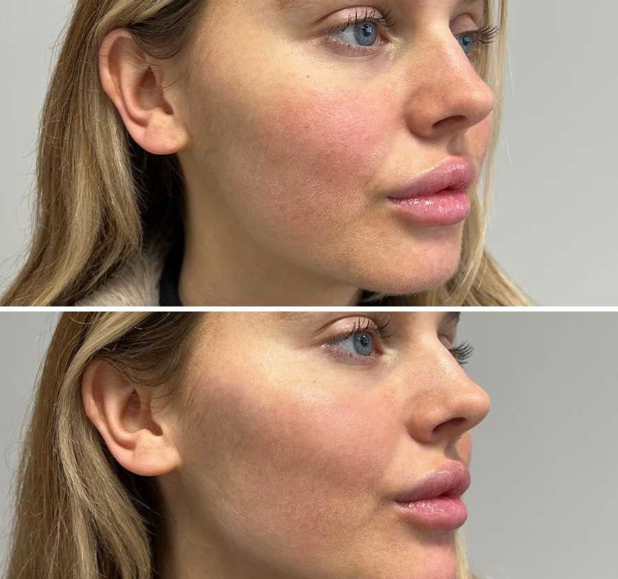 تزریق ژل گونه