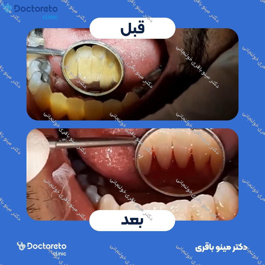 جرم گیری دندان با بروساژ🦷