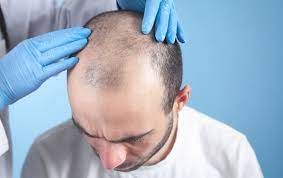 آزمایش ریزش مو در مردان