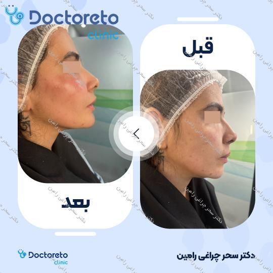 تزریق ژل چانه