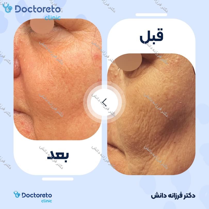 تزریق ژل گونه