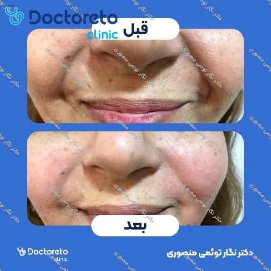 تزریق ژل خط خنده