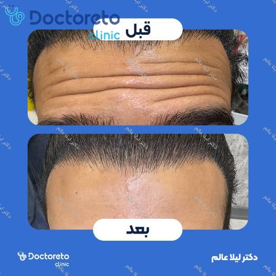 تزریق بوتاکس صورت 💉