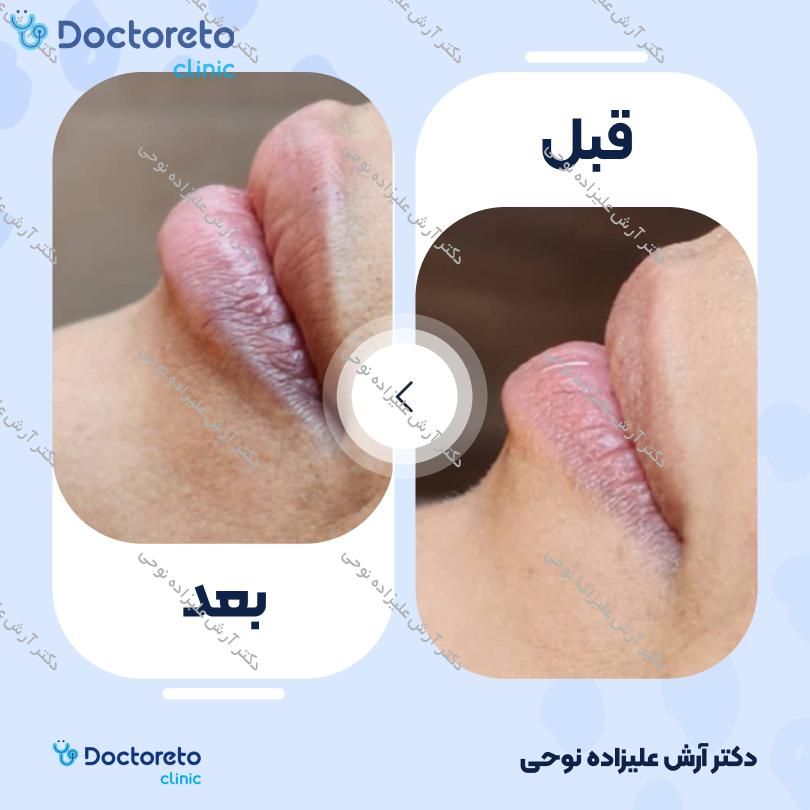 تزریق ژل لب