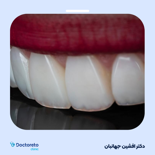 جرم گیری دندان با بروساژ