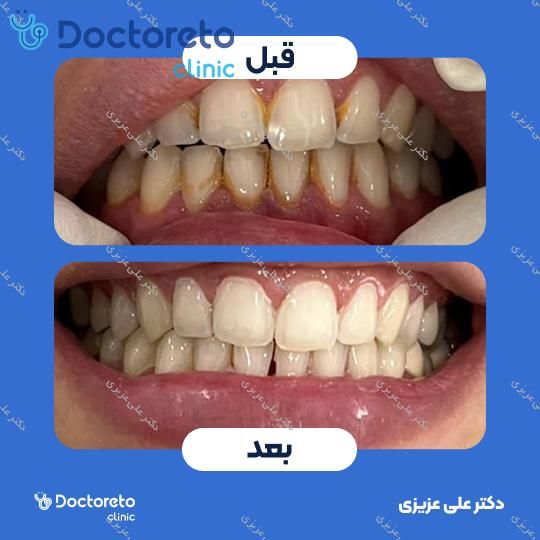 جرم گیری دندان با بروساژ🦷