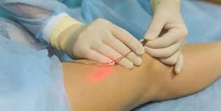 درمان عروق واریسی با لیزر عمقی (EVLA) با دستگاه دایود