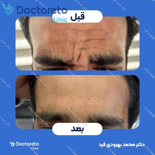 تزریق بوتاکس صورت 💉