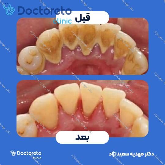 جرم گیری دندان با بروساژ🦷