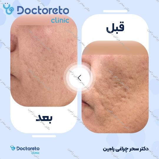 درمان ترک های پوستی و سفت کردن پوست با دستگاه آر اف فرکشنال (هر جلسه)