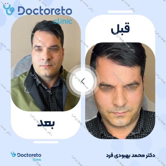تزریق بوتاکس صورت 💉