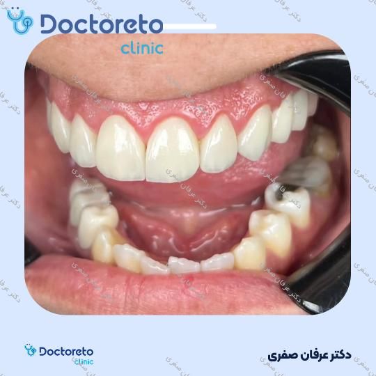 جرم گیری دندان با بروساژ 🦷
