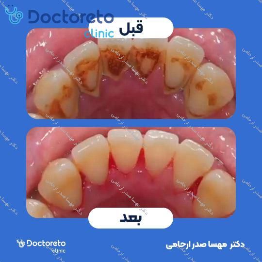 جرم گیری دندان با بروساژ🦷
