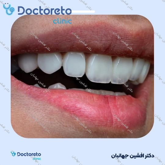پر کردن دندان