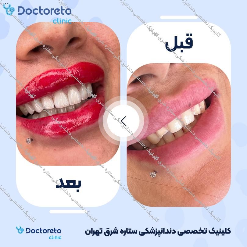 روکش دندان (هر واحد)