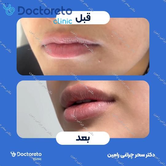 تزریق ژل لب