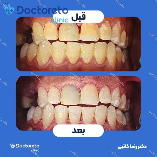 جرم گیری دندان با بروساژ🦷