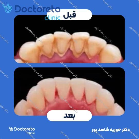 جرم گیری دندان با بروساژ🦷