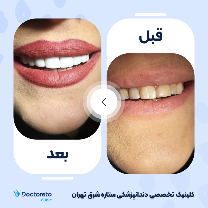 کامپوزیت دندان (هر واحد)