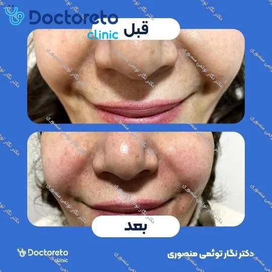 تزریق ژل خط خنده