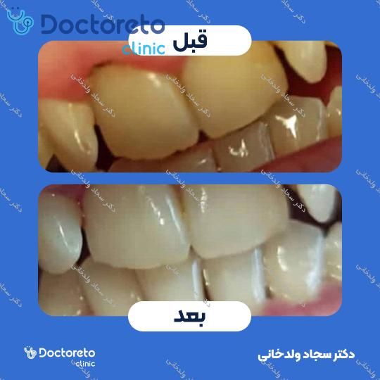 جرم گیری کامل دندان‌های دو فک با بروساژ🦷