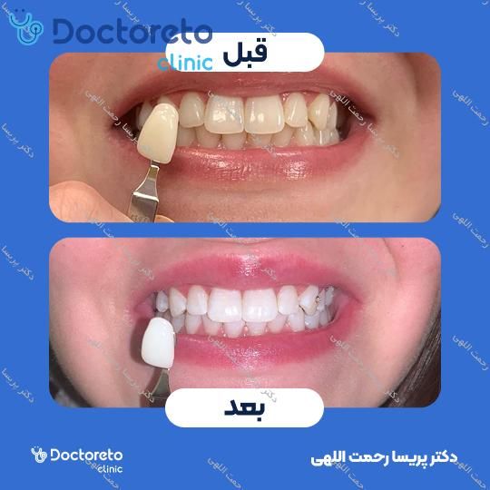 هوم بلیچینگ (سفید کردن دندان) دو فک با مواد آلمانی whitesmile