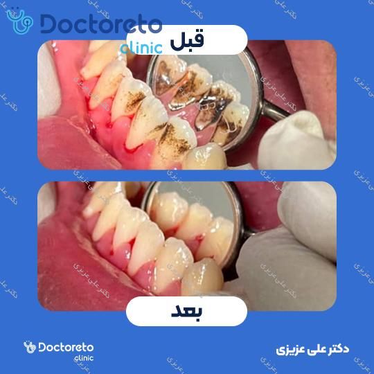 جرم گیری دندان با بروساژ🦷